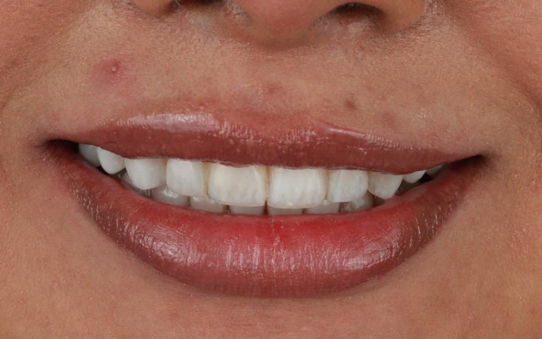después del diseño de sonrisa en resina; caso real de la página original