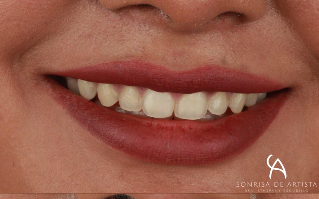 antes del diseño de sonrisa en resina; caso real de la página original